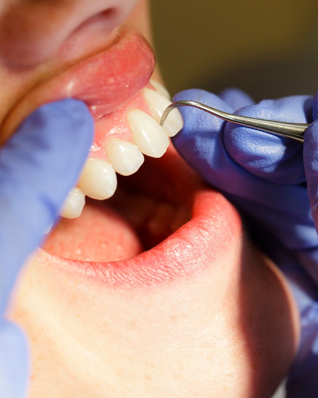 Limpieza dental